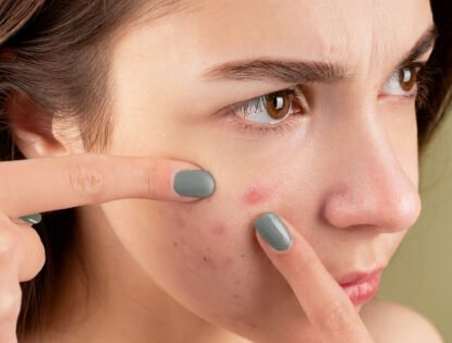 Muitas espinhas no rosto: qual a causa e como tratar?