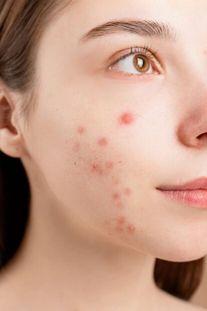 mulher branca com pele cheia de acne adulta