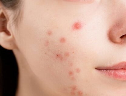 Acne da mulher adulta: como identificar e o melhor tratamento?