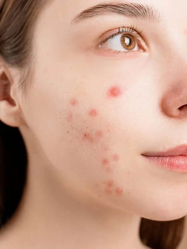 Acne da mulher adulta: como identificar e o melhor tratamento?