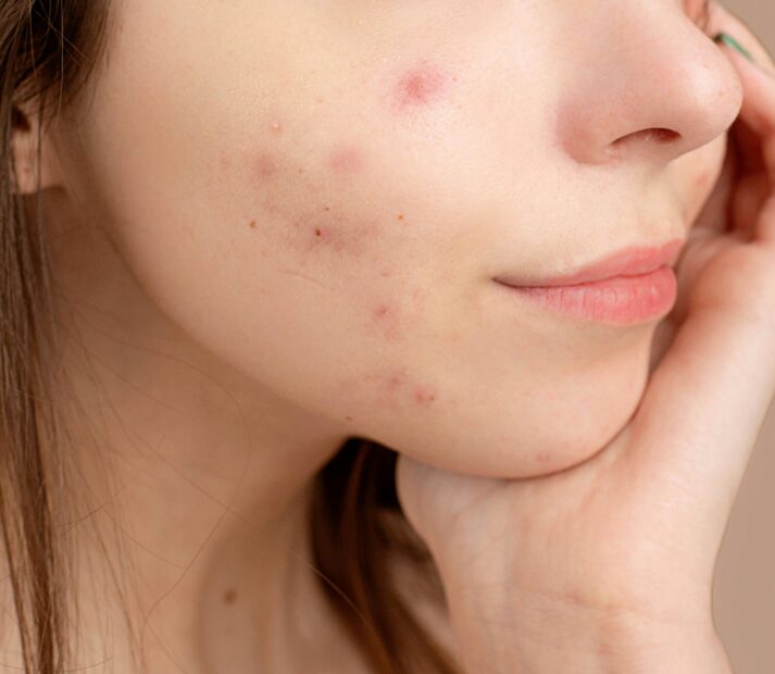 Pele com acne mitos e verdades para se cuidar melhor