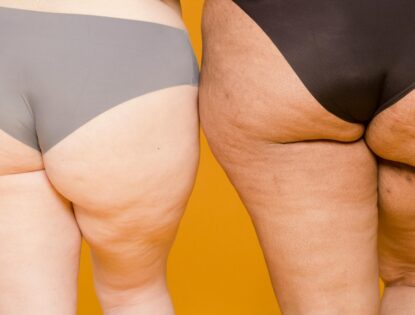 Como tratar Lipedema a doença que acomete Yasmim Brunet?