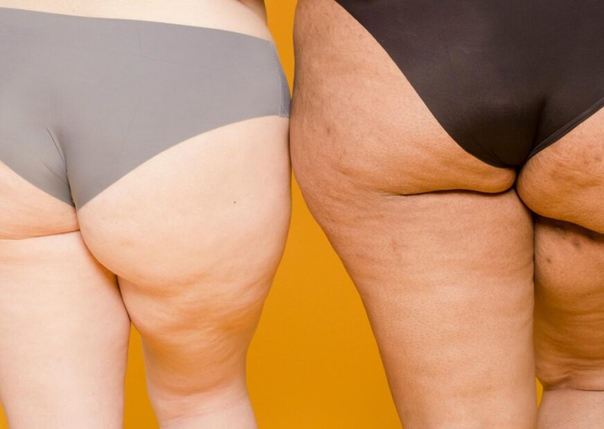 Como tratar Lipedema a doença que acomete Yasmim Brunet