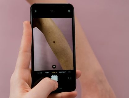 Sintomas iniciais de câncer de pele, cirurgia e como se prevenir