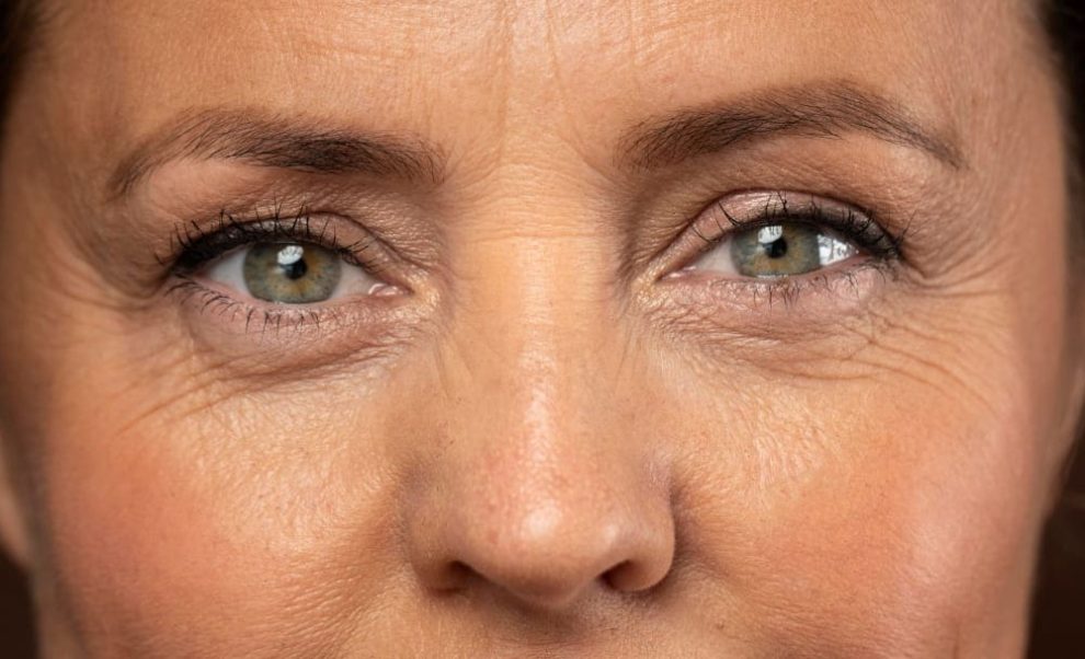 Olheiras na Menopausa Causas e Melhores Tratamentos