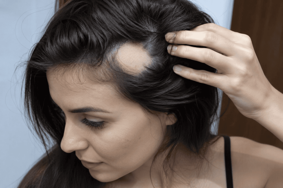 Virginia Fonseca revela ter alopecia areata: veja como tratar