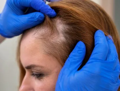 Por Que Seu Cabelo Está Caindo? As 5 Causas mais comuns em Mulheres