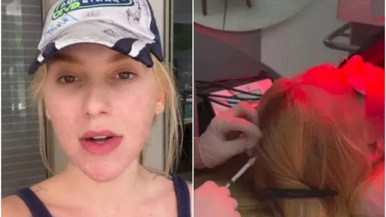 Virginia Fonseca revela ter alopecia areata: veja como tratar