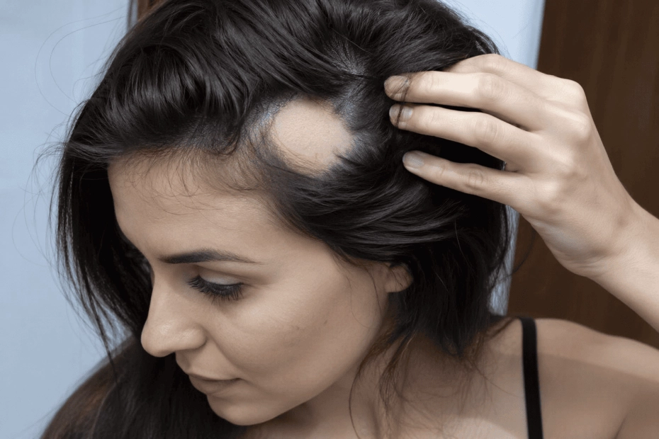 Virginia Fonseca revela ter alopecia areata: veja como tratar